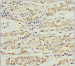 Immunohistochemistry of paraffin-embedded human gastric cancer using KCNS3 Antibody at dilution of 1:100