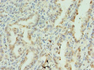 Immunohistochemistry of paraffin-embedded human lung cancer using the antibody at dilution of 1:100Rabbit anti-Human SDHC Polyclonal Antibody