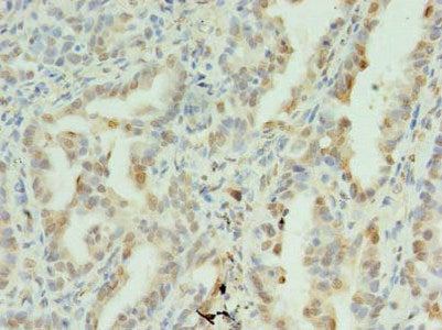 Immunohistochemistry of paraffin-embedded human lung cancer using the antibody at dilution of 1:100Rabbit anti-Human SDHC Polyclonal Antibody