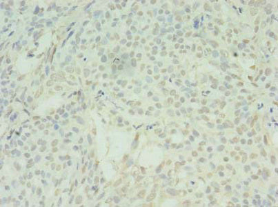 Immunohistochemistry of paraffin-embedded human breast cancer using SDHC Antibody at dilution of 1:100Rabbit anti-Human SDHC Polyclonal Antibody
