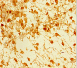 Immunohistochemistry of paraffin-embedded human melanoma using the antibody at dilution of 1:100Rabbit anti-Human SMAD5 Polyclonal Antibody