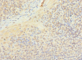 Immunohistochemistry of paraffin-embedded human tonsil tissue using PIP5K1A Antibody at dilution of 1:100Rabbit anti-Human PIP5K1A Polyclonal Antibody
