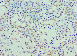 Immunohistochemistry of paraffin-embedded human breast cancer using COQ7 Antibody at dilution of 1:100Rabbit anti-Human COQ7 Polyclonal Antibody