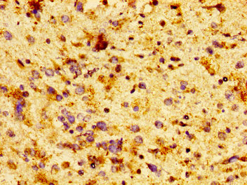 IHC image of CCT7 Antibody diluted at 1:100 and staining in paraffin-embedded human glioma performed on a Leica BondTM system. After dewaxing and hydration, antigen retrieval was mediated by high pressure in a citrate buffer (pH 6.0). Section was blocked with 10% normal goat serum 30min at RT. Then primary antibody (1% BSA) was incubated at 4°C overnight. The primary is detected by a biotinylated secondary antibody and visualized using an HRP conjugated SP system.Rabbit anti-Human CCT7 Polyclonal Antibody