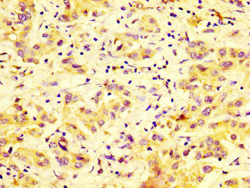 IHC image of the antibody diluted at 1:600 and staining in paraffin-embedded human liver cancer performed on a Leica BondTM system. After dewaxing and hydration, antigen retrieval was mediated by high pressure in a citrate buffer (pH 6.0). Section was blocked with 10% normal goat serum 30min at RT. Then primary antibody (1% BSA) was incubated at 4°C overnight. The primary is detected by a biotinylated secondary antibody and visualized using an HRP conjugated SP system.Rabbit anti-Human DUSP9 Polyclonal Antibody