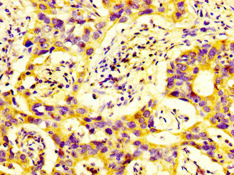 IHC image of DUSP9 Antibody diluted at 1:600 and staining in paraffin-embedded human bladder cancer performed on a Leica BondTM system. After dewaxing and hydration, antigen retrieval was mediated by high pressure in a citrate buffer (pH 6.0). Section was blocked with 10% normal goat serum 30min at RT. Then primary antibody (1% BSA) was incubated at 4°C overnight. The primary is detected by a biotinylated secondary antibody and visualized using an HRP conjugated SP system.Rabbit anti-Human DUSP9 Polyclonal Antibody
