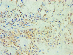 Immunohistochemistry of paraffin-embedded human breast cancer using SPIN2B Antibody at dilution of 1:100Rabbit anti-Human SPIN2B Polyclonal Antibody