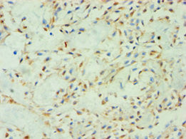 Immunohistochemistry of paraffin-embedded human breast cancer using SPIN2B Antibody at dilution of 1:100Rabbit anti-Human SPIN2B Polyclonal Antibody