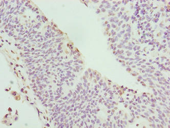 Immunohistochemistry of paraffin-embedded human bladder cancer using CYBC1 Antibody at dilution of 1:100Rabbit anti-Human CYBC1 Polyclonal Antibody