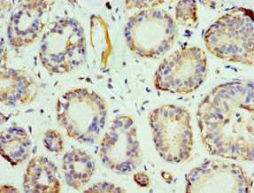 Immunohistochemistry of paraffin-embedded human breast cancer using PHB2 Antibody at dilution of 1:100Rabbit anti-Human PHB2 Polyclonal Antibody