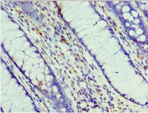 Immunohistochemistry of paraffin-embedded human colon cancer using PHB2 Antibody at dilution of 1:100Rabbit anti-Human PHB2 Polyclonal Antibody
