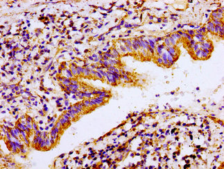 Immunohistochemistry of paraffin-embedded human lung cancer using ACO2 Antibody at dilution of 1:100