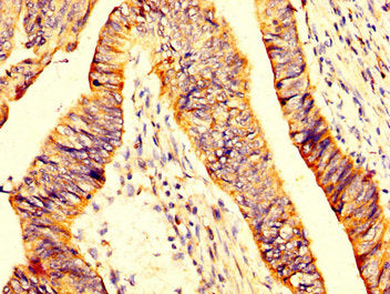 IHC image of MYOC Antibody diluted at 1:200 and staining in paraffin-embedded human colon cancer performed on a Leica BondTM system. After dewaxing and hydration, antigen retrieval was mediated by high pressure in a citrate buffer (pH 6.0). Section was blocked with 10% normal goat serum 30min at RT. Then primary antibody (1% BSA) was incubated at 4°C overnight. The primary is detected by a biotinylated secondary antibody and visualized using an HRP conjugated SP system.Rabbit anti-Human MYOC Polyclonal Antibody