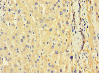 Immunohistochemistry of paraffin-embedded human liver cancer using TSC22D3 Antibody at dilution of 1:100Rabbit anti-Human TSC22D3 Polyclonal Antibody