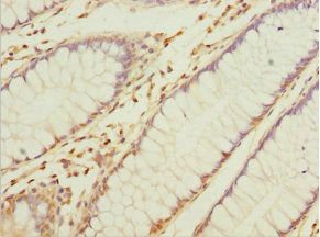 Immunohistochemistry of paraffin-embedded human colon cancer using NAPG Antibody at dilution of 1:100Rabbit anti-Human NAPG Polyclonal Antibody