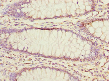 Immunohistochemistry of paraffin-embedded human colon cancer using EYA3 Antibody at dilution of 1:100Rabbit anti-Human EYA3 Polyclonal Antibody