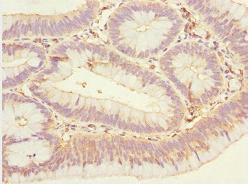 Immunohistochemistry of paraffin-embedded human colon cancer using EYA3 Antibody at dilution of 1:100Rabbit anti-Human EYA3 Polyclonal Antibody