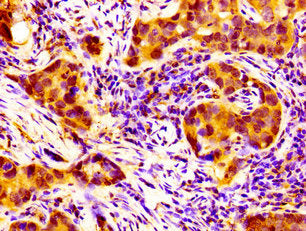 IHC image of the antibody diluted at 1:100 and staining in paraffin-embedded human pancreatic cancer performed on a Leica BondTM system. After dewaxing and hydration, antigen retrieval was mediated by high pressure in a citrate buffer (pH 6.0). Section was blocked with 10% normal goat serum 30min at RT. Then primary antibody (1% BSA) was incubated at 4°C overnight. The primary is detected by a biotinylated secondary antibody and visualized using an HRP conjugated SP system.Rabbit anti-Human NPAS2 Polyclonal Antibody