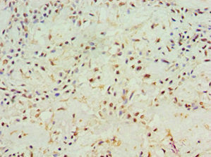 Immunohistochemistry of paraffin-embedded human breast cancer using ACY1 Antibody at dilution of 1:100Rabbit anti-Human ACY1 Polyclonal Antibody