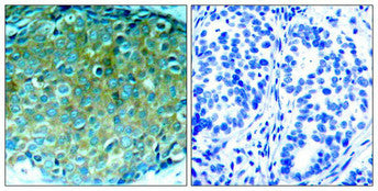 Immunohistochemical analysis of paraffin-embedded human breast carcinoma tissue using PAK1(Ab-212) Antibody(left) or the same antibody preincubated with blocking peptide(right).Rabbit anti-Human PAK1 Polyclonal Antibody