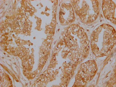 IHC image of ZKSCAN3 Antibody diluted at 1:200 and staining in paraffin-embedded human prostate cancer performed on a Leica BondTM system. After dewaxing and hydration, antigen retrieval was mediated by high pressure in a citrate buffer (pH 6.0). Section was blocked with 10% normal goat serum 30min at RT. Then primary antibody (1% BSA) was incubated at 4°C overnight. The primary is detected by a Goat anti-rabbit polymer IgG labeled by HRP and visualized using 0.05% DAB.Rabbit anti-Human ZKSCAN3 Polyclonal Antibody