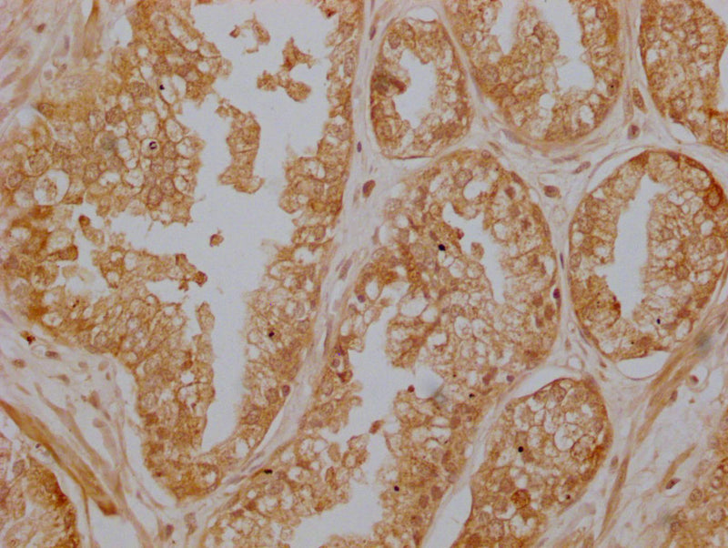 IHC image of ZKSCAN3 Antibody diluted at 1:200 and staining in paraffin-embedded human prostate cancer performed on a Leica BondTM system. After dewaxing and hydration, antigen retrieval was mediated by high pressure in a citrate buffer (pH 6.0). Section was blocked with 10% normal goat serum 30min at RT. Then primary antibody (1% BSA) was incubated at 4°C overnight. The primary is detected by a Goat anti-rabbit polymer IgG labeled by HRP and visualized using 0.05% DAB.Rabbit anti-Human ZKSCAN3 Polyclonal Antibody