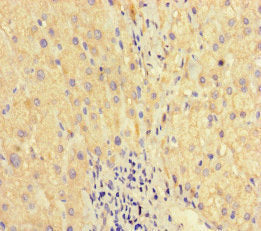 Immunohistochemistry of paraffin-embedded human liver cancer using WAC Antibody at dilution of 1:100