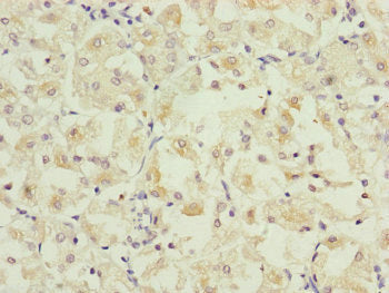 Immunohistochemistry of paraffin-embedded human gastric cancer using the antibody at dilution of 1:100Rabbit anti-Human PARD6B Polyclonal Antibody