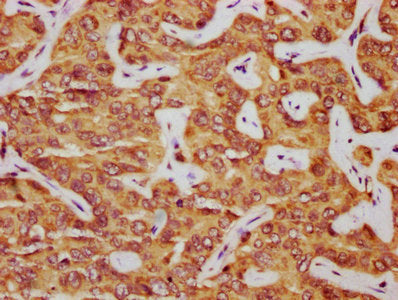 IHC image of PARD6B Antibody diluted at 1:325 and staining in paraffin-embedded human liver cancer performed on a Leica BondTM system. After dewaxing and hydration, antigen retrieval was mediated by high pressure in a citrate buffer (pH 6.0). Section was blocked with 10% normal goat serum 30min at RT. Then primary antibody (1% BSA) was incubated at 4°C overnight. The primary is detected by a biotinylated secondary antibody and visualized using an HRP conjugated SP system.Rabbit anti-Human PARD6B Polyclonal Antibody