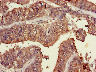 Immunohistochemistry of paraffin-embedded human endometrial cancer using the antibody at dilution of 1:100Rabbit anti-Human TRIM54 Polyclonal Antibody