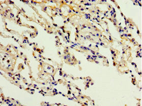 Immunohistochemistry of paraffin-embedded human lung tissue using ADAM33 Antibody at dilution of 1:100Rabbit anti-Human ADAM33 Polyclonal Antibody