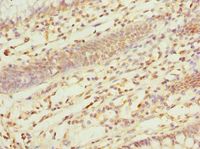 Immunohistochemistry of paraffin-embedded human colon cancer using the antibody at dilution of 1:100Rabbit anti-Human ZDHHC5 Polyclonal Antibody