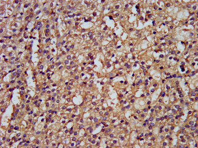 IHC image of DLST Antibody diluted at 1:300 and staining in paraffin-embedded human adrenal gland tissue performed on a Leica BondTM system. After dewaxing and hydration, antigen retrieval was mediated by high pressure in a citrate buffer (pH 6.0). Section was blocked with 10% normal goat serum 30min at RT. Then primary antibody (1% BSA) was incubated at 4°C overnight. The primary is detected by a biotinylated secondary antibody and visualized using an HRP conjugated SP system.Rabbit anti-Human DLST Polyclonal Antibody