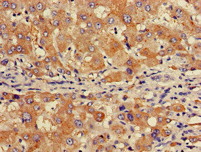 Immunohistochemistry of paraffin-embedded human liver cancer using the antibody at dilution of 1:100Rabbit anti-Human GABARAPL1 Polyclonal Antibody