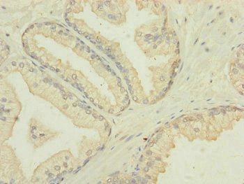 Immunohistochemistry of paraffin-embedded human prostate cancer using MTIF3 Antibody at dilution of 1:100Rabbit anti-Human MTIF3 Polyclonal Antibody