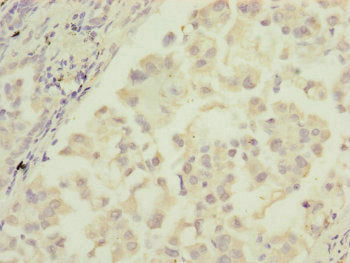 Immunohistochemistry of paraffin-embedded human lung cancer using MTIF3 Antibody at dilution of 1:100Rabbit anti-Human MTIF3 Polyclonal Antibody