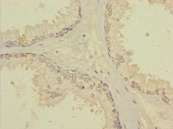 Immunohistochemistry of paraffin-embedded human prostate cancer using TTC12 Antibody at dilution of 1:100Rabbit anti-Human TTC12 Polyclonal Antibody