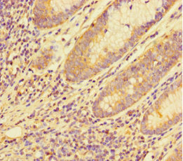 Immunohistochemistry of paraffin-embedded human colon cancer using the antibody at dilution of 1:100