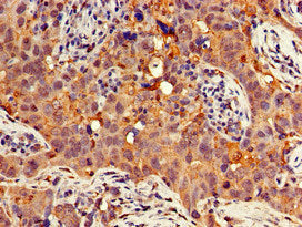 Immunohistochemistry of paraffin-embedded human pancreatic cancer using GNB4 Antibody at dilution of 1:100Rabbit anti-Human GNB4 Polyclonal Antibody