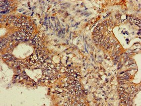 Immunohistochemistry of paraffin-embedded human colon cancer using GNB4 Antibody at dilution of 1:100Rabbit anti-Human GNB4 Polyclonal Antibody