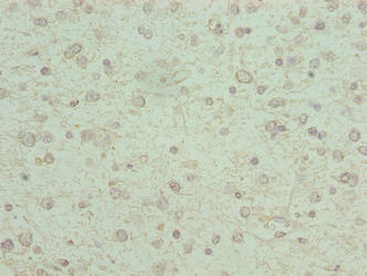 Immunohistochemistry of paraffin-embedded human glioma using KCNK13 Antibody at dilution of 1:100