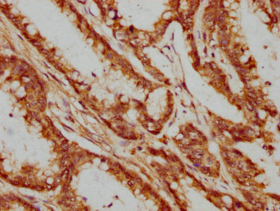 IHC image of XAB2 Antibody diluted at 1:400 and staining in paraffin-embedded human colon cancer performed on a Leica BondTM system. After dewaxing and hydration, antigen retrieval was mediated by high pressure in a citrate buffer (pH 6.0). Section was blocked with 10% normal goat serum 30min at RT. Then primary antibody (1% BSA) was incubated at 4°C overnight. The primary is detected by a biotinylated secondary antibody and visualized using an HRP conjugated SP system.