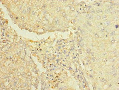 Immunohistochemistry of paraffin-embedded human lung cancer using AARSD1 Antibody at dilution of 1:100