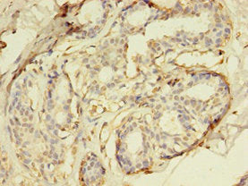 Immunohistochemistry of paraffin-embedded human breast cancer using DUSP26 Antibody at dilution of 1:100