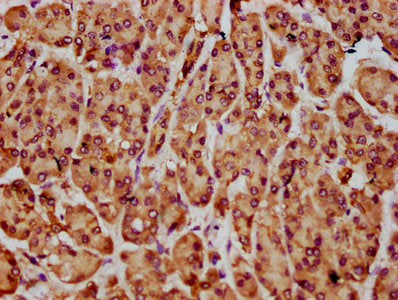 IHC image of NLN Antibody diluted at 1:300 and staining in paraffin-embedded human pancreatic cancer performed on a Leica BondTM system. After dewaxing and hydration, antigen retrieval was mediated by high pressure in a citrate buffer (pH 6.0). Section was blocked with 10% normal goat serum 30min at RT. Then primary antibody (1% BSA) was incubated at 4°C overnight. The primary is detected by a biotinylated secondary antibody and visualized using an HRP conjugated SP system.Rabbit anti-Human NLN Polyclonal Antibody