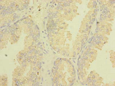 Immunohistochemistry of paraffin-embedded human prostate cancer using TSGA10 Antibody at dilution of 1:100Rabbit anti-Human TSGA10 Polyclonal Antibody
