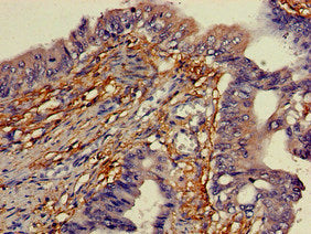 Immunohistochemistry of paraffin-embedded human colon cancer using YIPF3 Antibody at dilution of 1:100Rabbit anti-Human YIPF3 Polyclonal Antibody