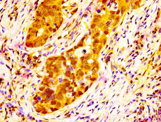 IHC image of the antibody diluted at 1:300 and staining in paraffin-embedded human pancreatic cancer performed on a Leica BondTM system. After dewaxing and hydration, antigen retrieval was mediated by high pressure in a citrate buffer (pH 6.0). Section was blocked with 10% normal goat serum 30min at RT. Then primary antibody (1% BSA) was incubated at 4°C overnight. The primary is detected by a biotinylated secondary antibody and visualized using an HRP conjugated SP system.