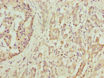 Immunohistochemistry of paraffin-embedded human pancreatic cancer using DEFB129 Antibody at dilution of 1:100Rabbit anti-Human DEFB129 Polyclonal Antibody