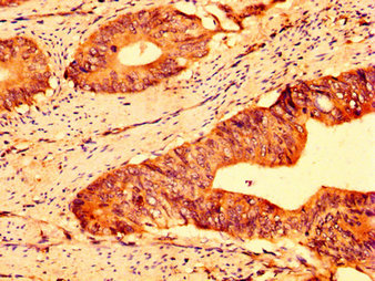IHC image of ABCG5 Antibody diluted at 1:500 and staining in paraffin-embedded human colon cancer performed on a Leica BondTM system. After dewaxing and hydration, antigen retrieval was mediated by high pressure in a citrate buffer (pH 6.0). Section was blocked with 10% normal goat serum 30min at RT. Then primary antibody (1% BSA) was incubated at 4°C overnight. The primary is detected by a biotinylated secondary antibody and visualized using an HRP conjugated SP system.